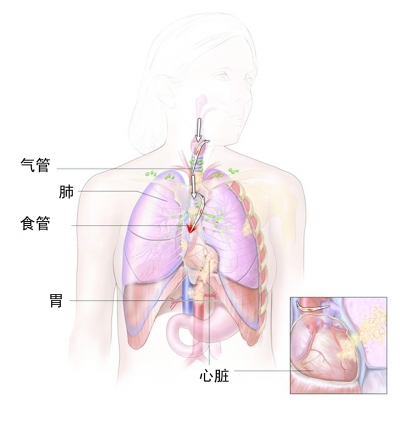 鱼刺 戳进心脏主动脉 开胸